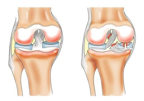 υγιές γόνατο και οστεοαρθρίτιδα της άρθρωσης του γόνατος